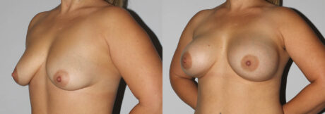 Breast Augmentation case #5607