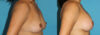 Breast Augmentation case #5603 slider thumbnail