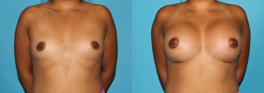 Breast Augmentation case #5659