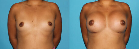 Breast Augmentation case #5659