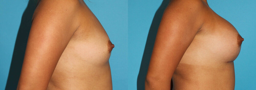 Breast Augmentation case #5659
