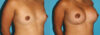 Breast Augmentation case #5659 slider thumbnail