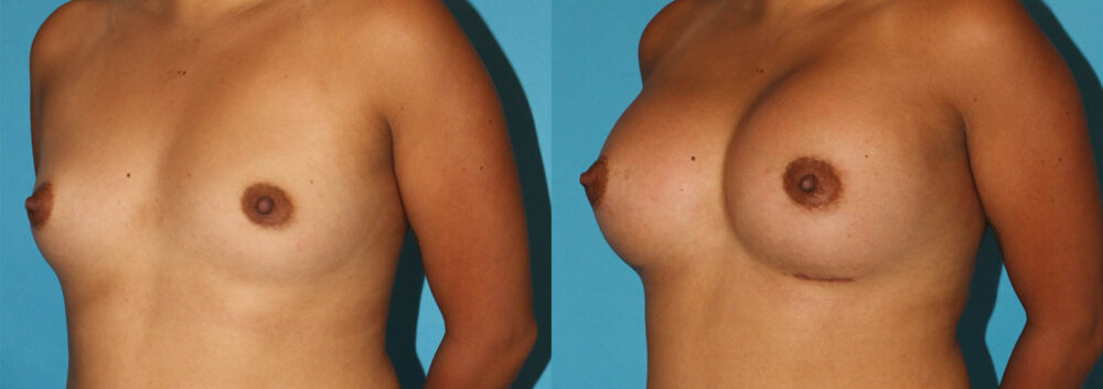 Breast Augmentation case #5659