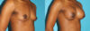 Breast Augmentation case #5666 slider thumbnail