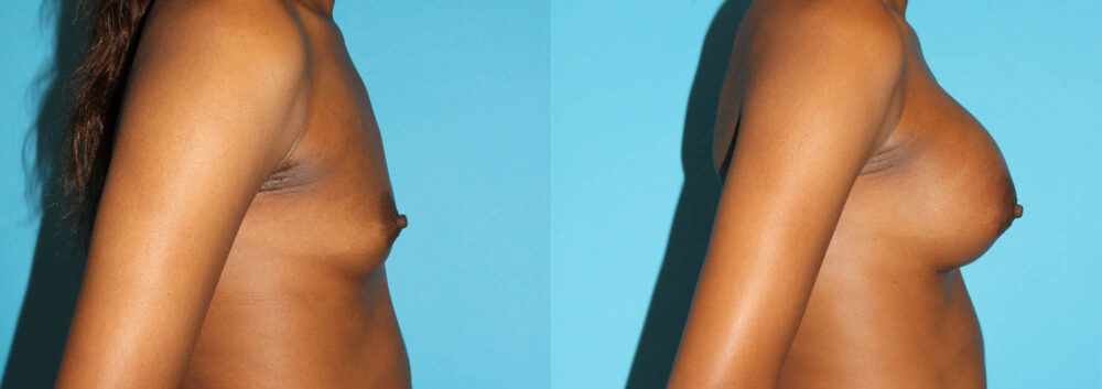 Breast Augmentation case #5666