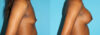 Breast Augmentation case #5666 slider thumbnail