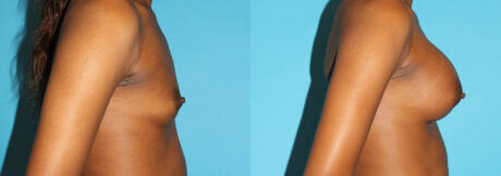 Breast Augmentation case #5666