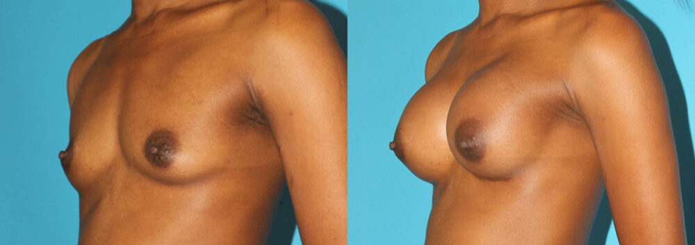 Breast Augmentation case #5666