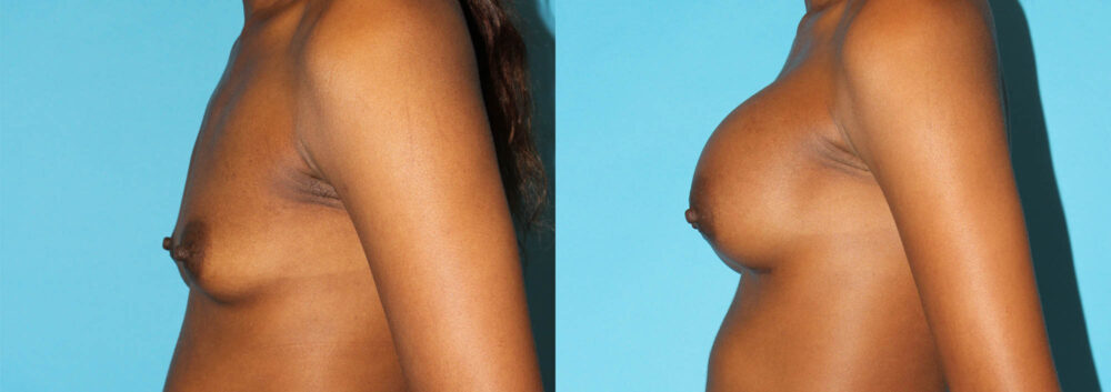 Breast Augmentation case #5666