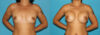 Breast Augmentation case #5653 slider thumbnail