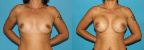 Breast Augmentation case #5653
