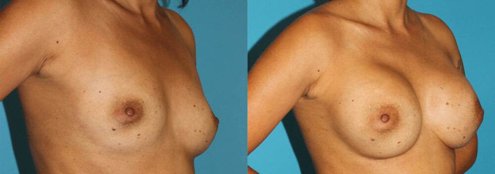 Breast Augmentation case #5653