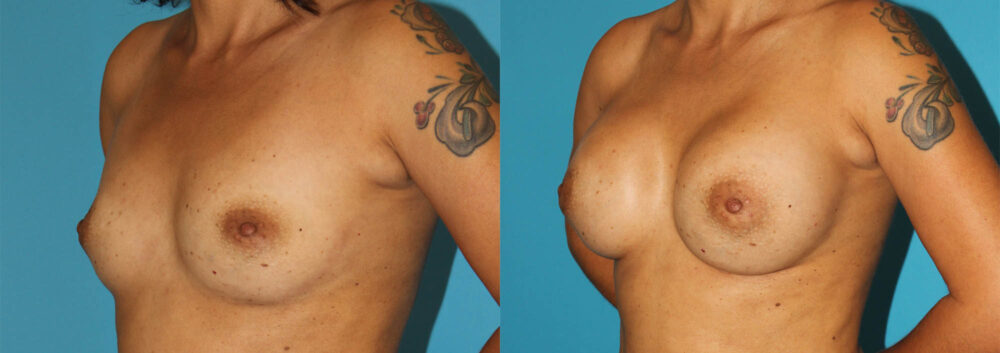 Breast Augmentation case #5653