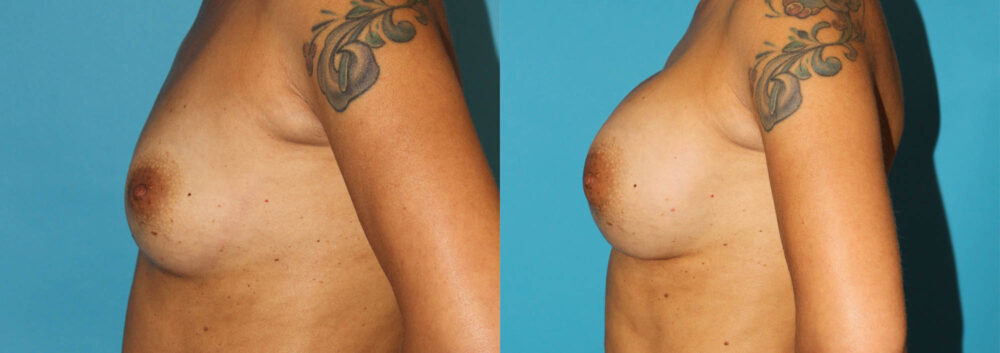 Breast Augmentation case #5653