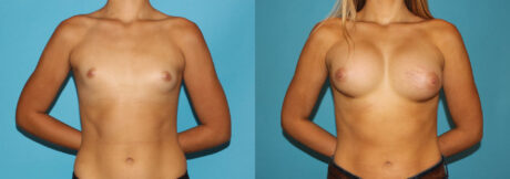 Breast Augmentation case #5626