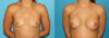 Breast Augmentation case #5672 slider thumbnail