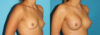 Breast Augmentation case #5672 slider thumbnail