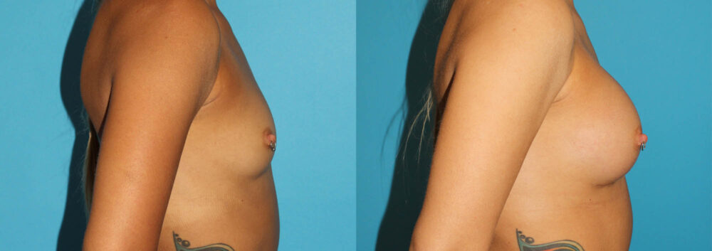Breast Augmentation case #5672