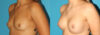 Breast Augmentation case #5672 slider thumbnail