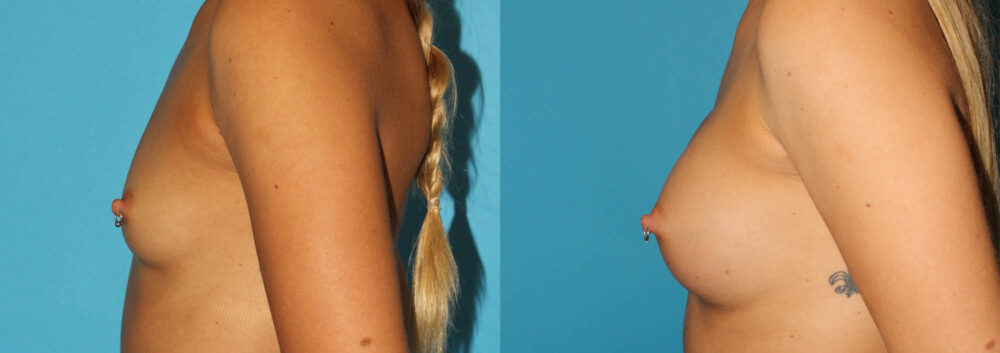 Breast Augmentation case #5672