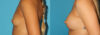 Breast Augmentation case #5672 slider thumbnail