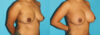 Breast Augmentation case #5678 slider thumbnail