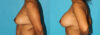 Breast Augmentation case #5678 slider thumbnail