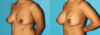 Breast Augmentation case #5678 slider thumbnail