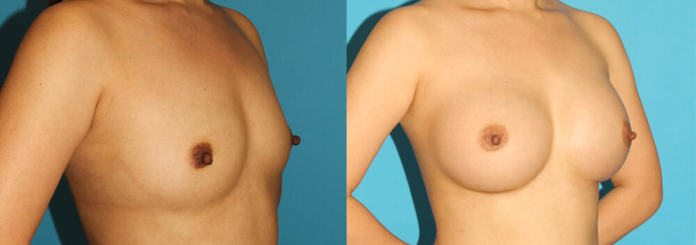 Breast Augmentation case #6250