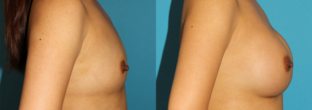 Breast Augmentation case #6250