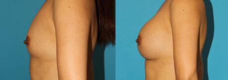 Breast Augmentation case #6250