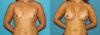 Breast Augmentation case #5632 slider thumbnail