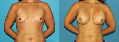 Breast Augmentation case #5632