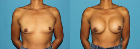Breast Augmentation case #6256