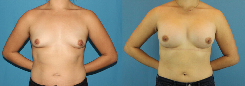 Breast Augmentation case #6262