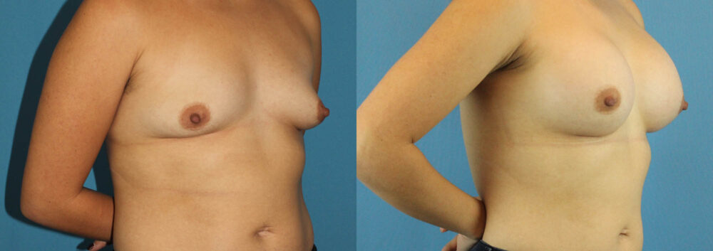 Breast Augmentation case #6262