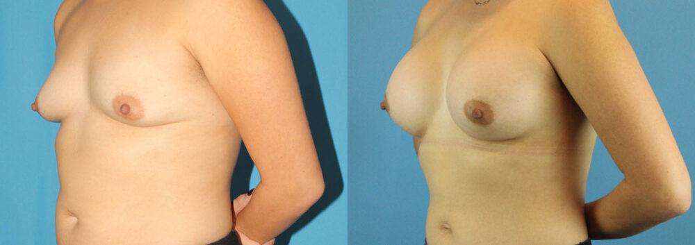 Breast Augmentation case #6262