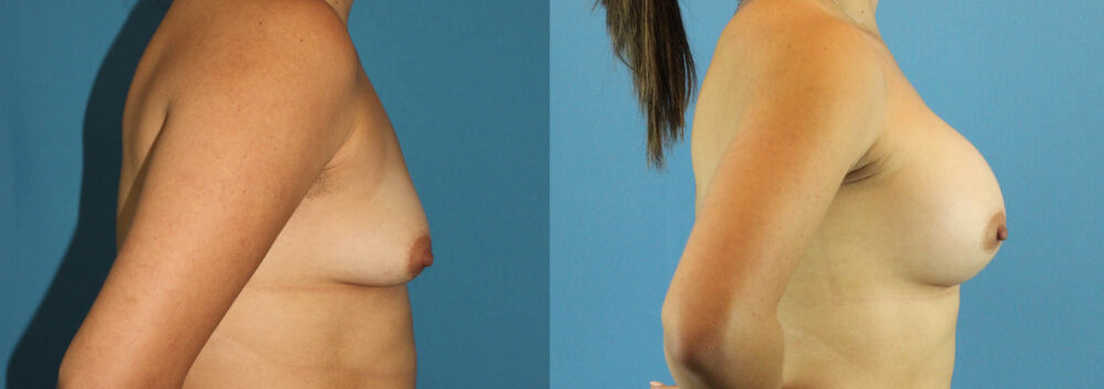 Breast Augmentation case #6262