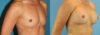 Breast Augmentation case #6273 slider thumbnail