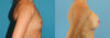 Breast Augmentation case #6273 slider thumbnail