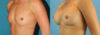 Breast Augmentation case #6273 slider thumbnail