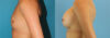 Breast Augmentation case #6273 slider thumbnail