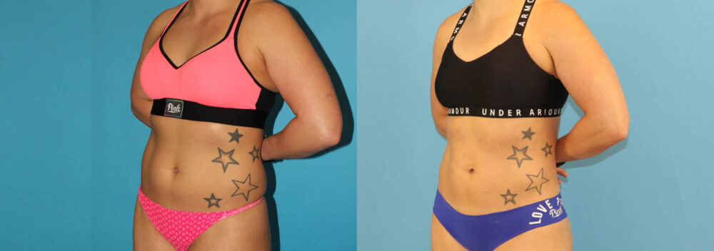 Liposuction case #6009