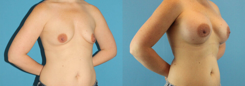 Breast Augmentation case #6268