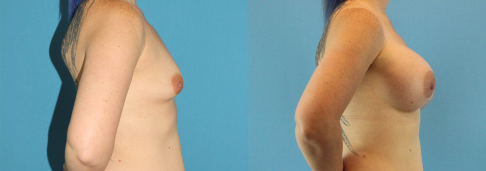 Breast Augmentation case #6268