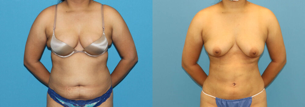 Liposuction case #6011