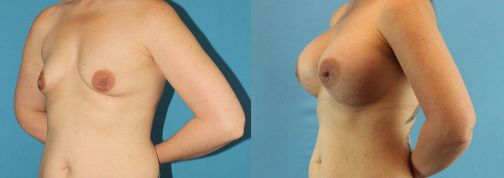 Breast Augmentation case #6268