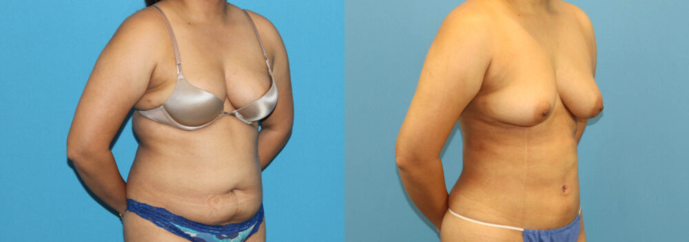 Liposuction case #6011