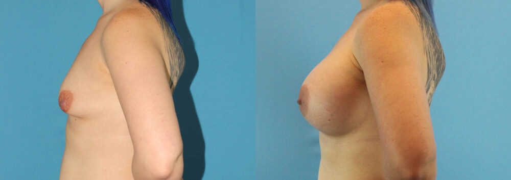 Breast Augmentation case #6268