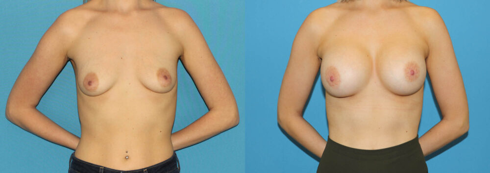 Breast Augmentation case #6279